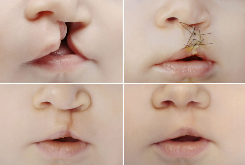 Close up on the lips of baby before and after lip and palate cleft surgery.